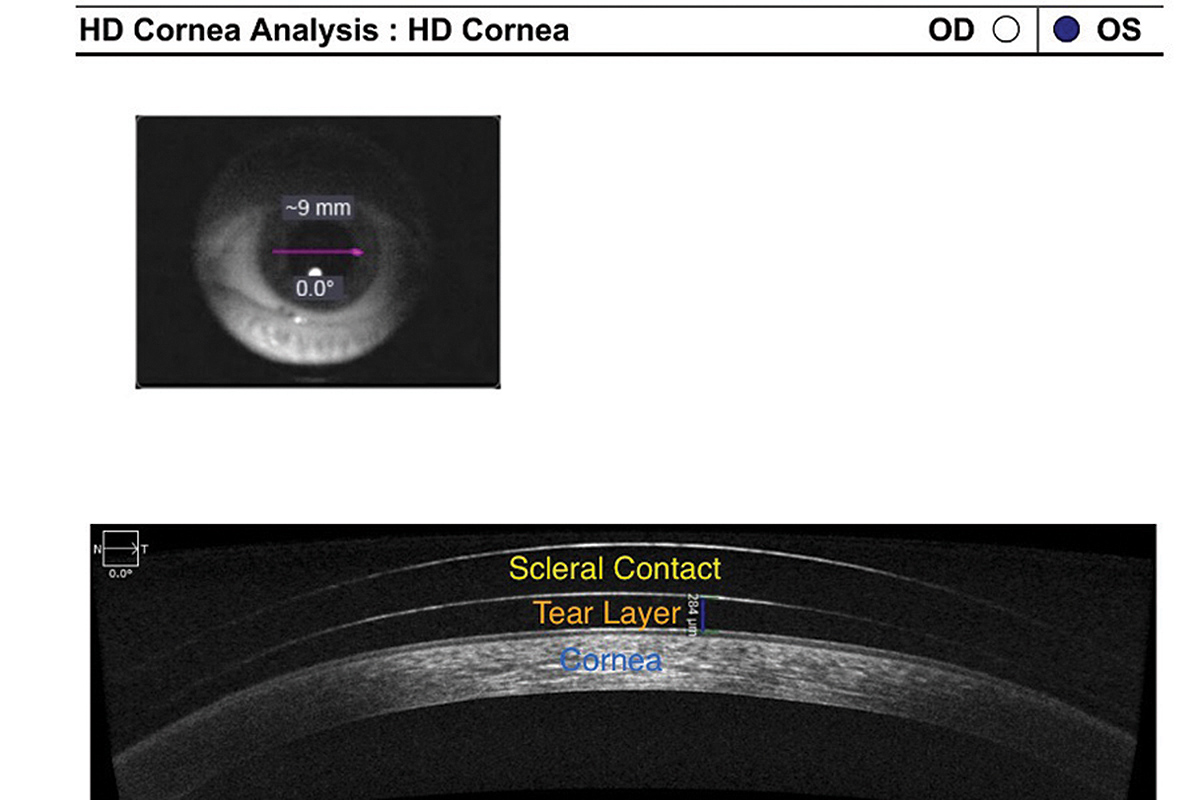 Cornea Analysis Cornea Analysis